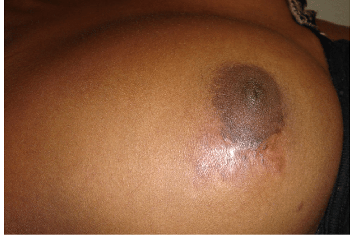 Right breast after 4 months of treatment for tuberculosis