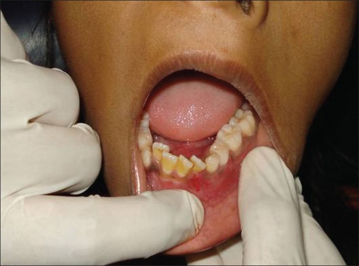Jaw-Bone-Infection