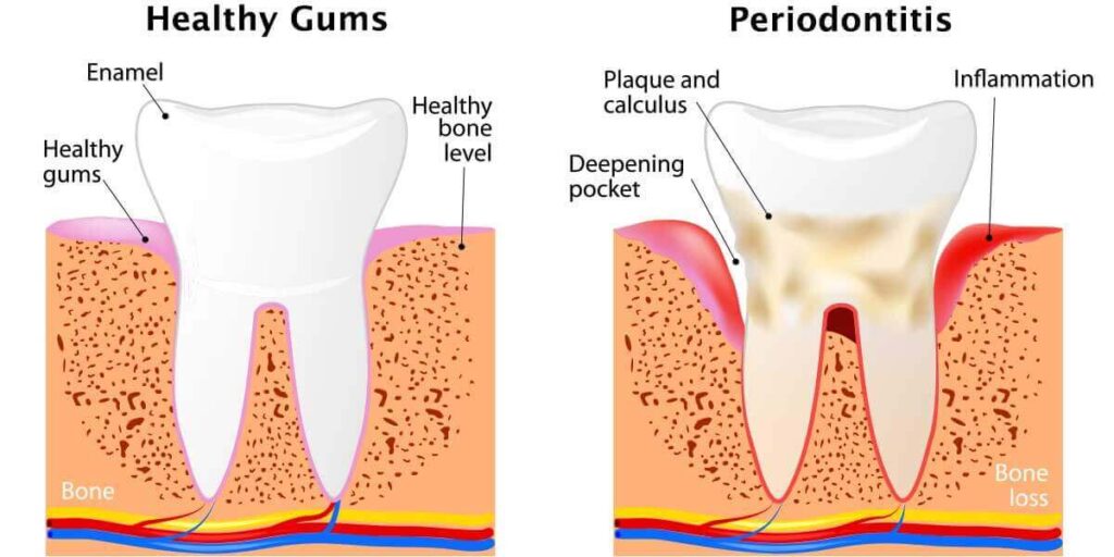 Gingivitis and Periodontitis