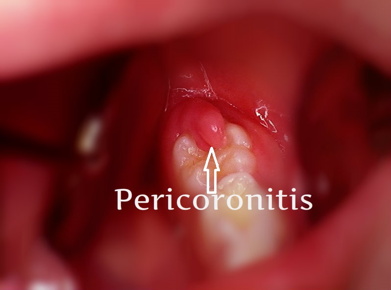 pericoronitis infection