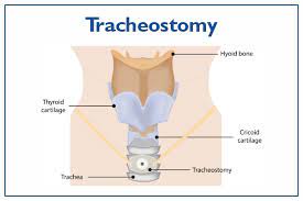 tracheostomy procedure